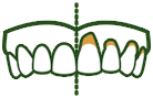 Cause of Tooth Sensitivity - Abfraction