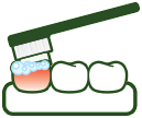 Cause of Tooth Sensitivity - Abrasion