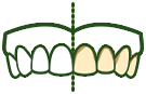 Cause of Tooth Sensitivity - Erosion